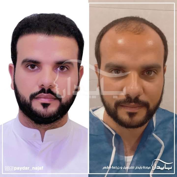نتيجة حقيقية قبل وبعد زراعة الشعر - حالة 1
