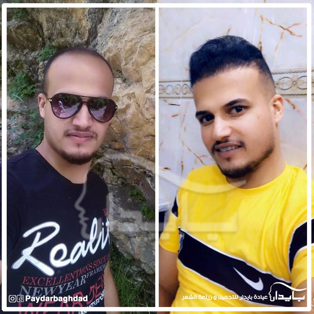 نتيجة حقيقية قبل وبعد زراعة الشعر - حالة 3